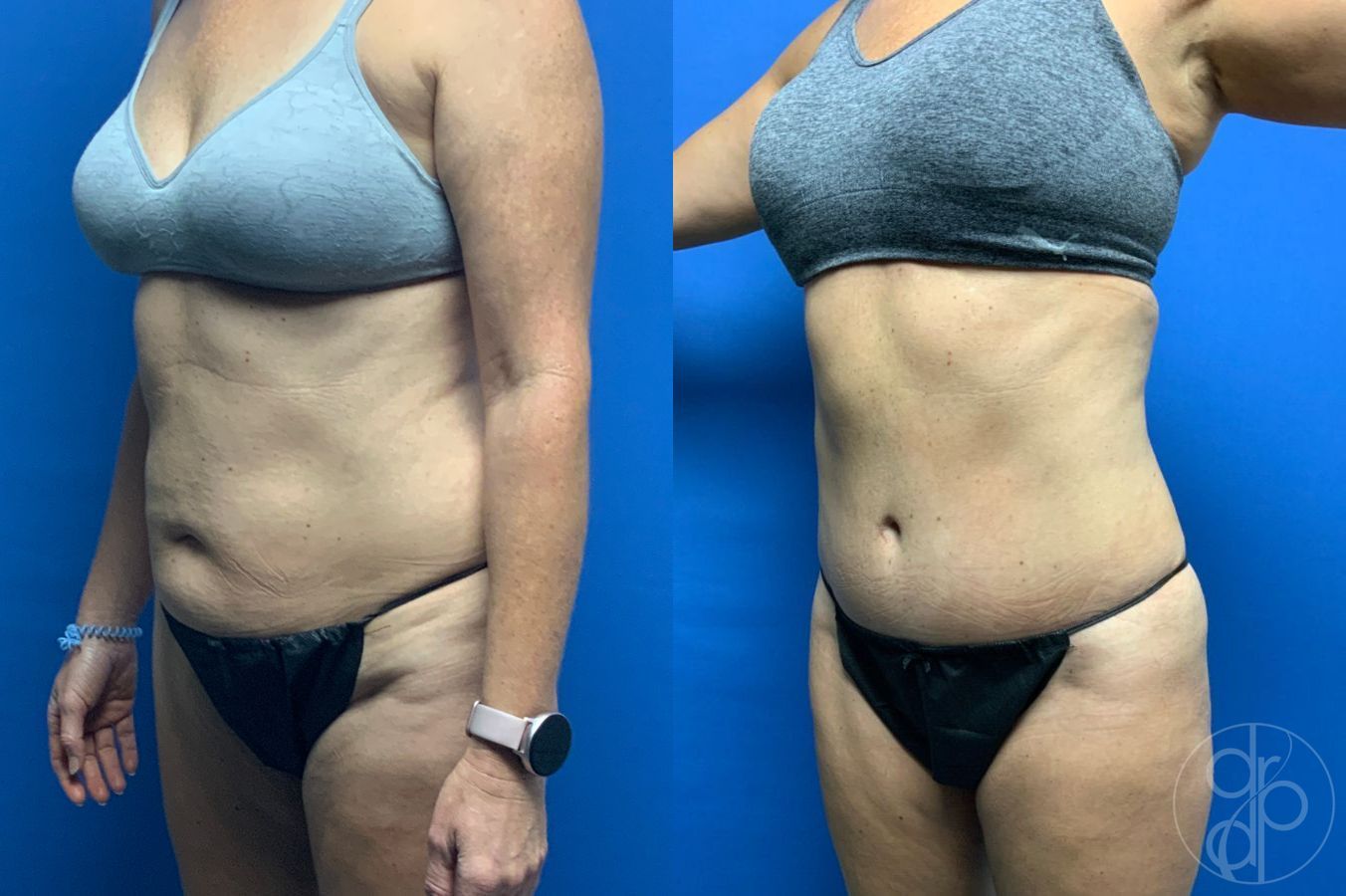 Before and after Liposuction case 46422 - Angle 3