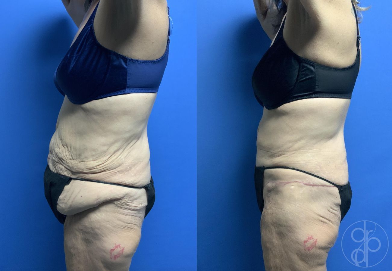 Abdominoplasty - Thumbnail 2