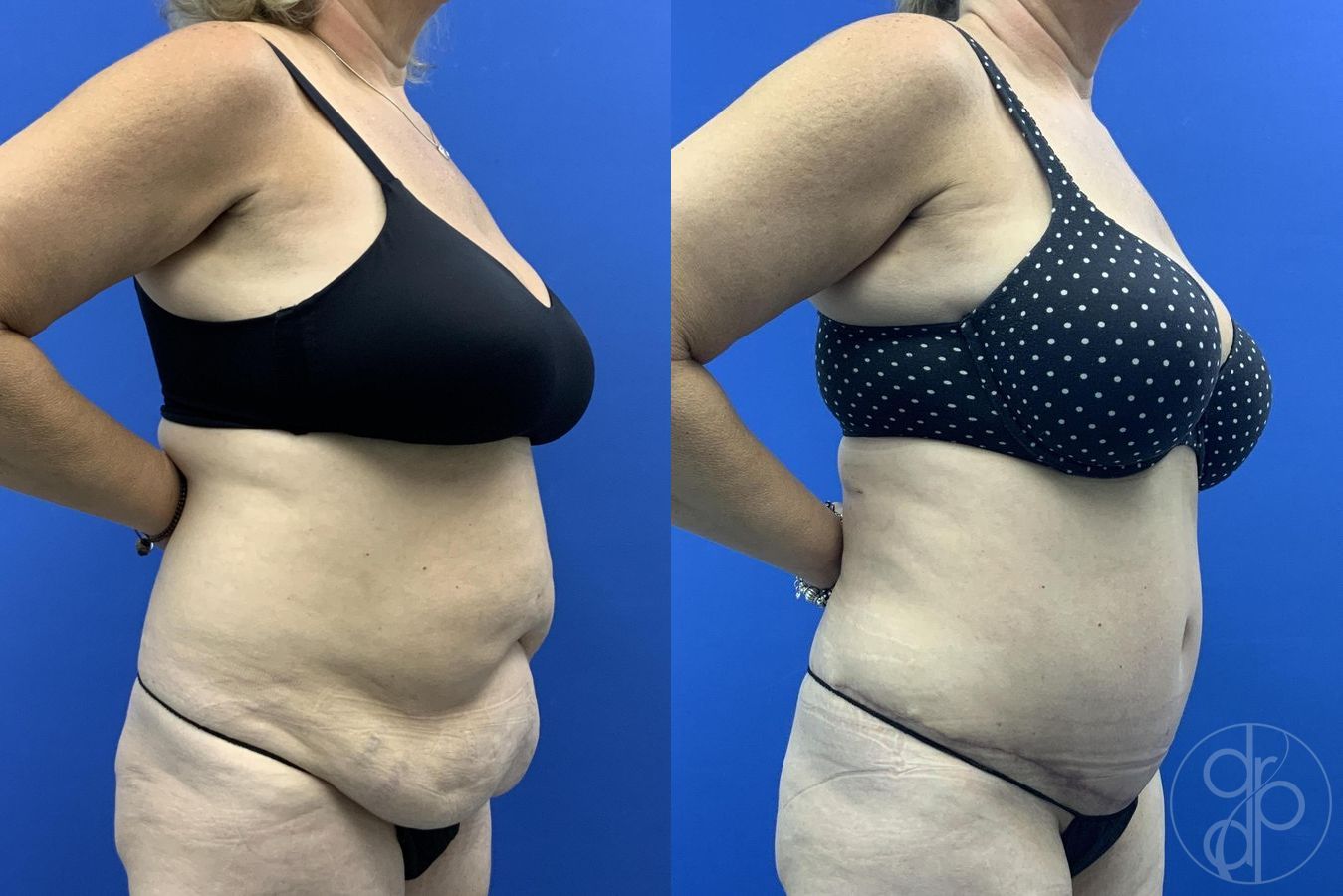 Before and after Abdominoplasty case 29619 - Angle 3