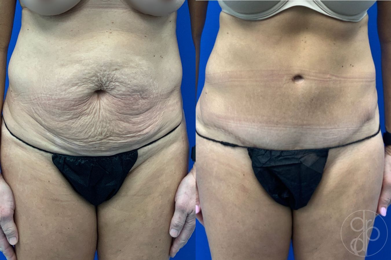 Before and after Abdominoplasty case 46417
