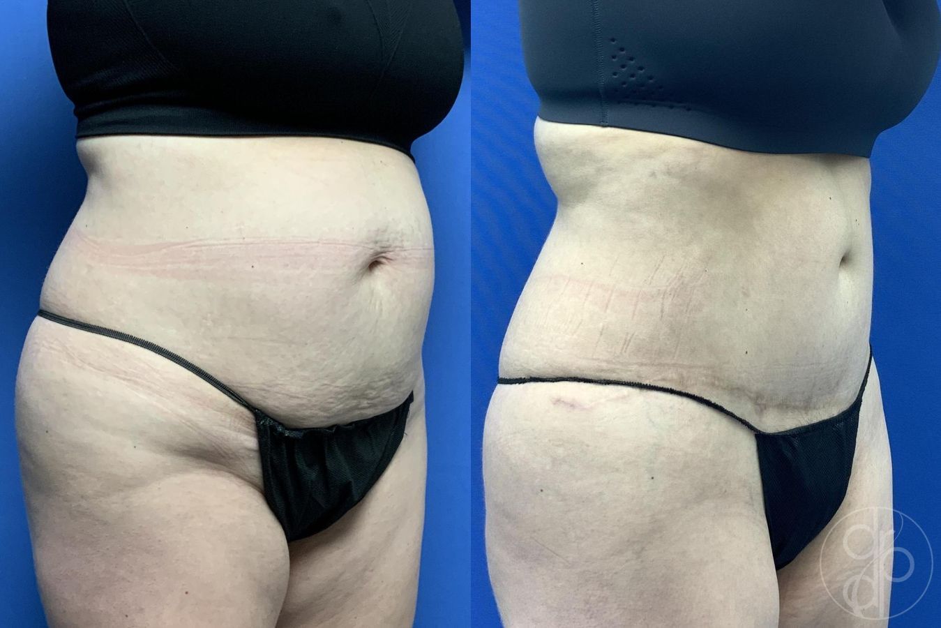 Before and after Abdominoplasty case 30018 - Angle 3