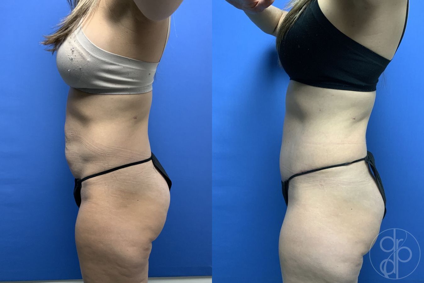 Before and after Abdominoplasty case 29580 - Angle 5