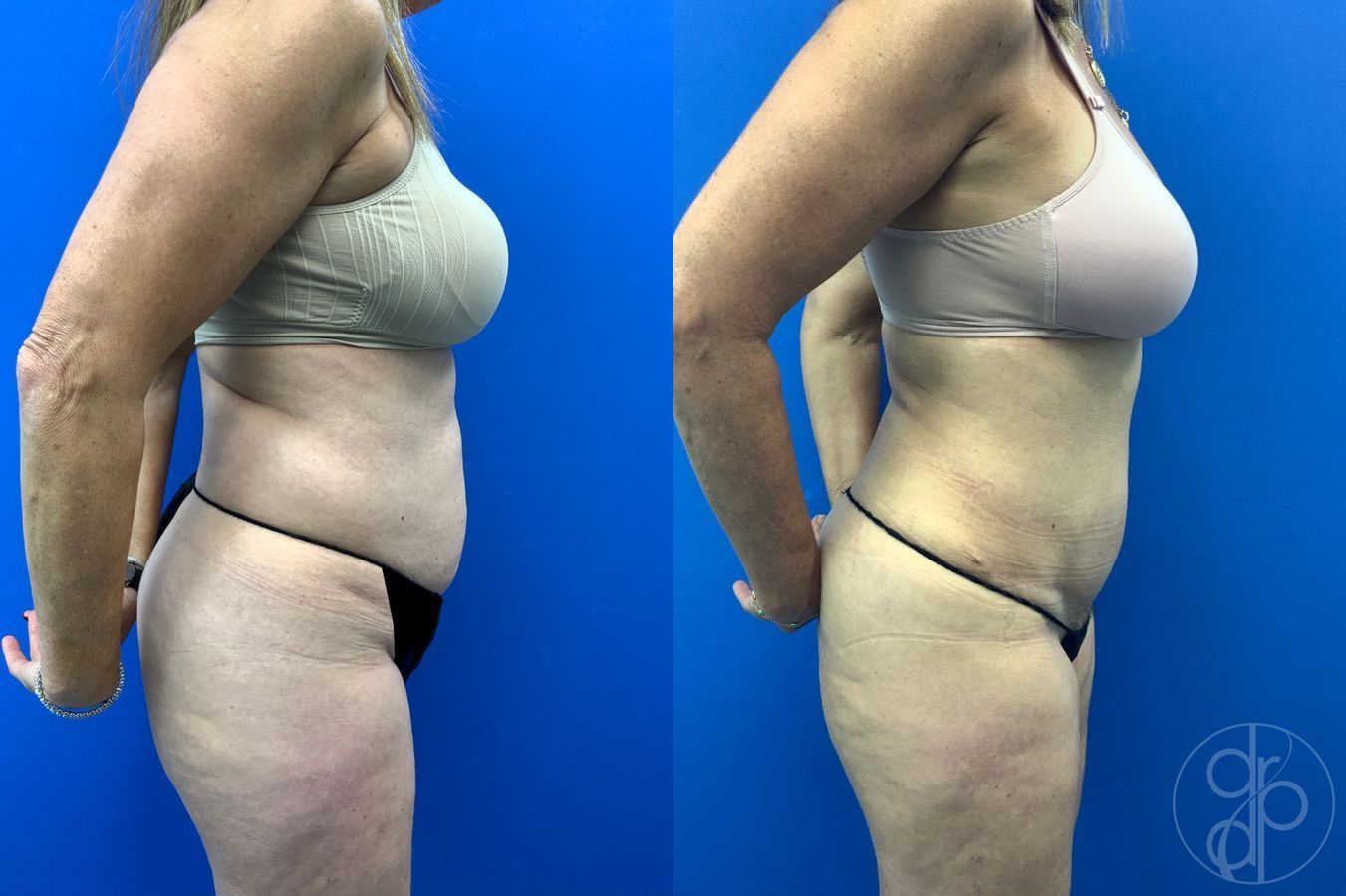 Before and after Abdominoplasty case 46404 - Angle 8