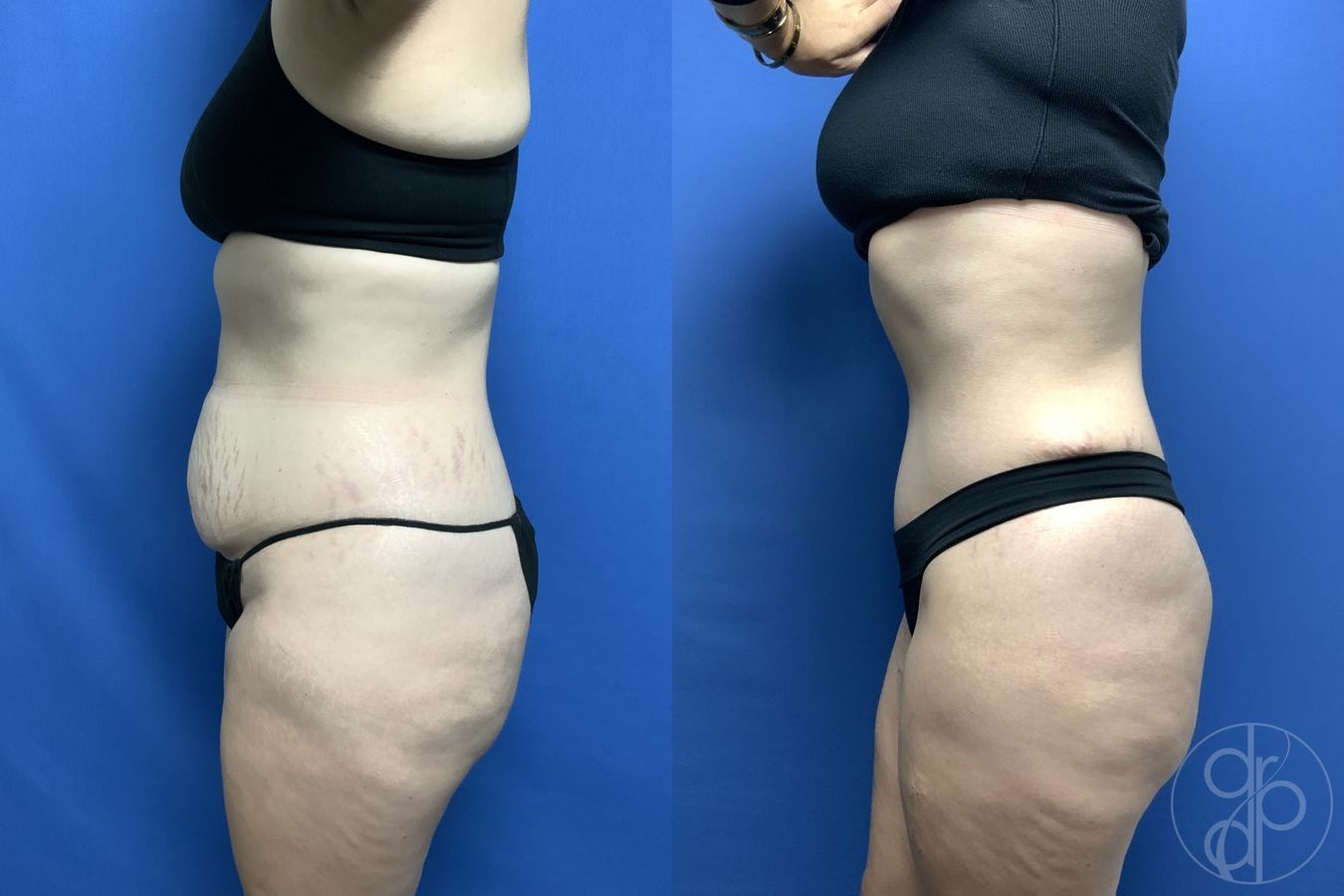 Before and after Abdominoplasty case 29538 - Angle 3