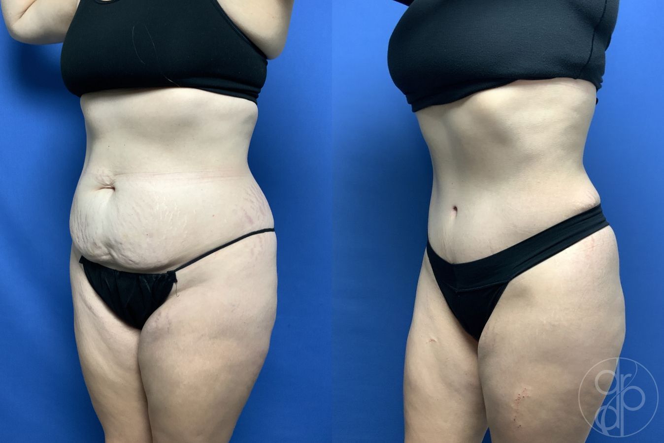 Before and after Abdominoplasty case 29538 - Angle 2