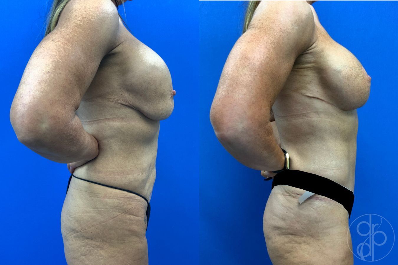 Before and after Mommy Makeover case 50316 - Angle 6
