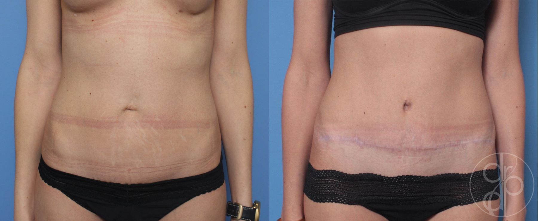Before and after Abdominoplasty case 29522