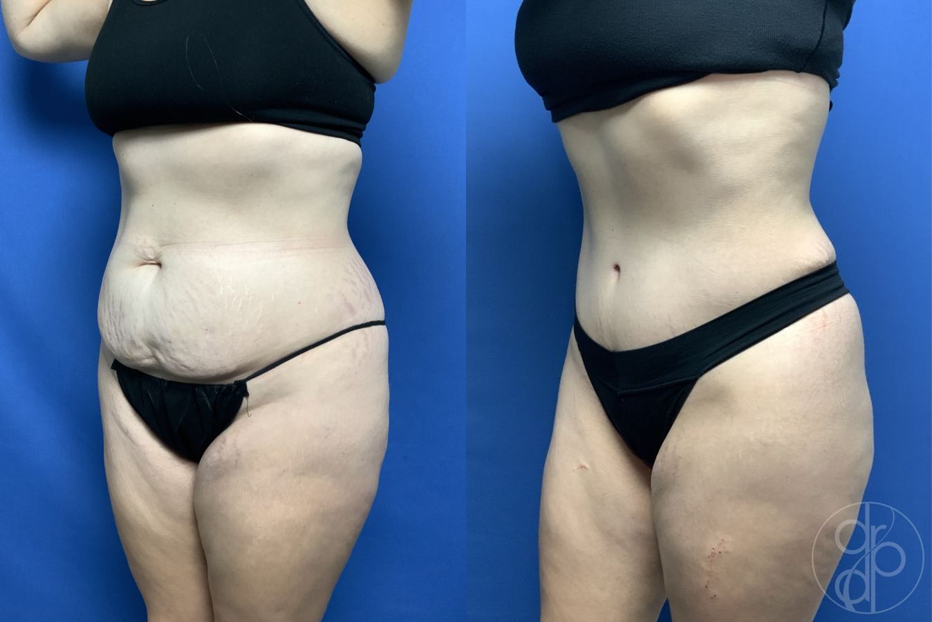 Before and after Abdominoplasty case 29538 - Angle 2
