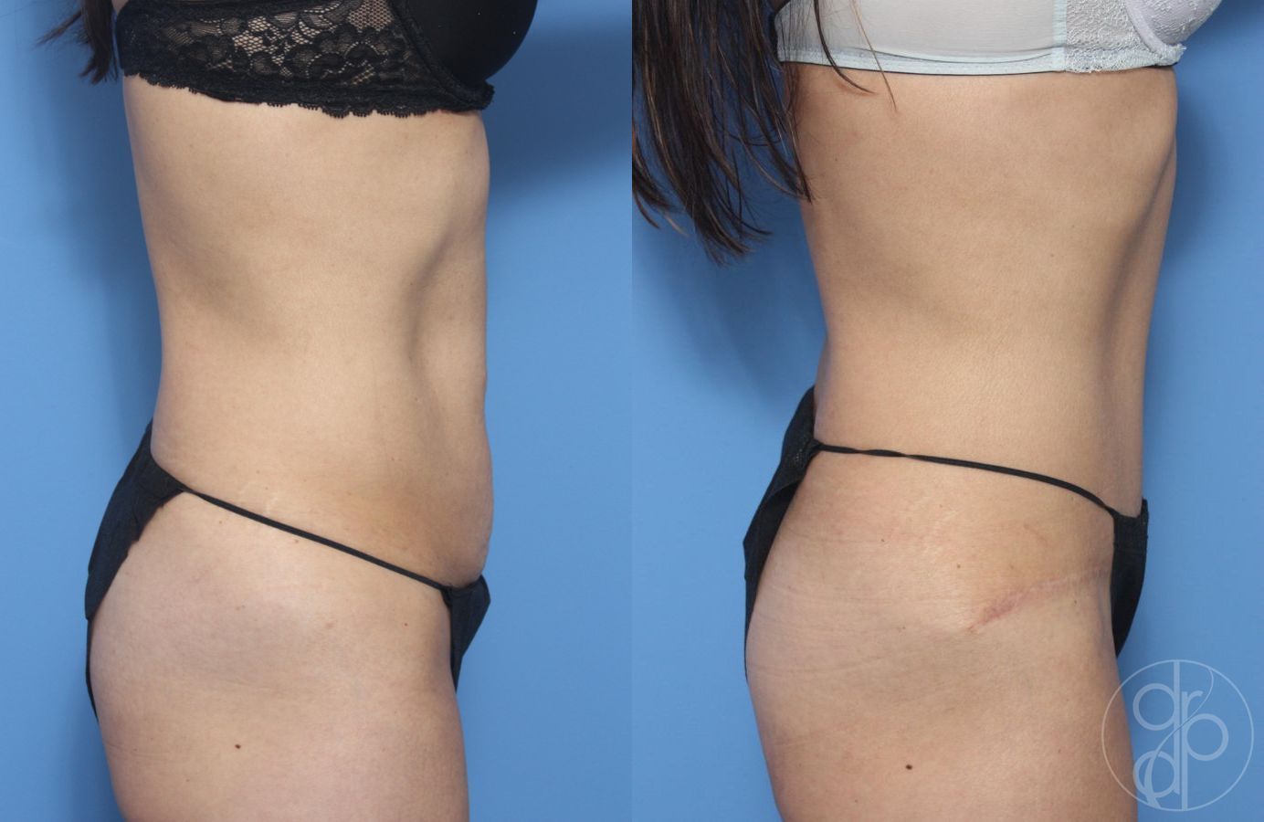 Before and after Abdominoplasty case 29524 - Angle 2