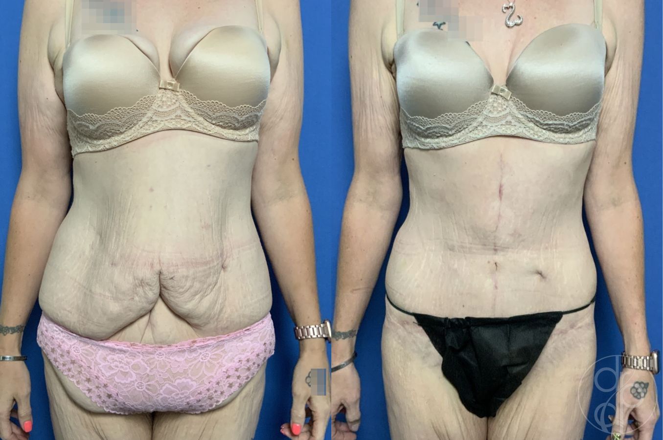 Before and after Abdominoplasty case 29535