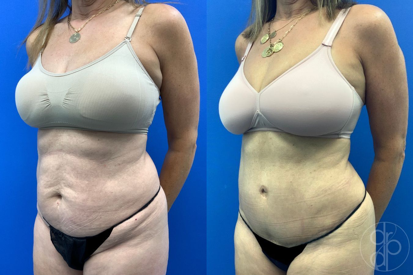 Before and after Abdominoplasty case 46404 - Angle 3