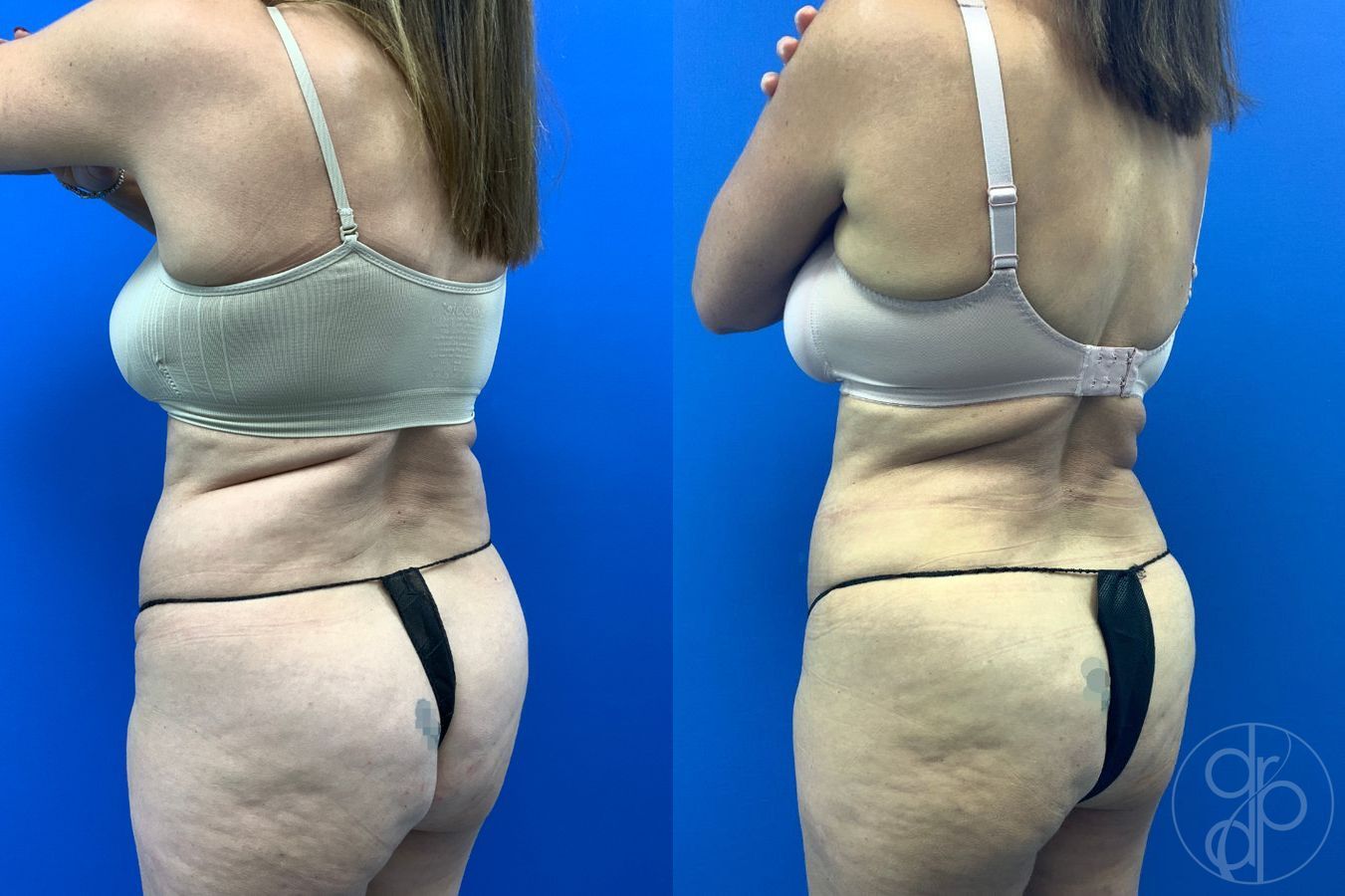 Before and after Abdominoplasty case 46404 - Angle 5