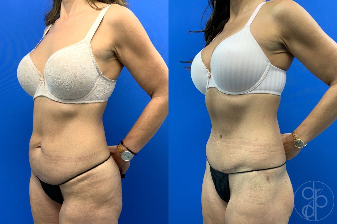Before and after Abdominoplasty case 43480 - Angle 3