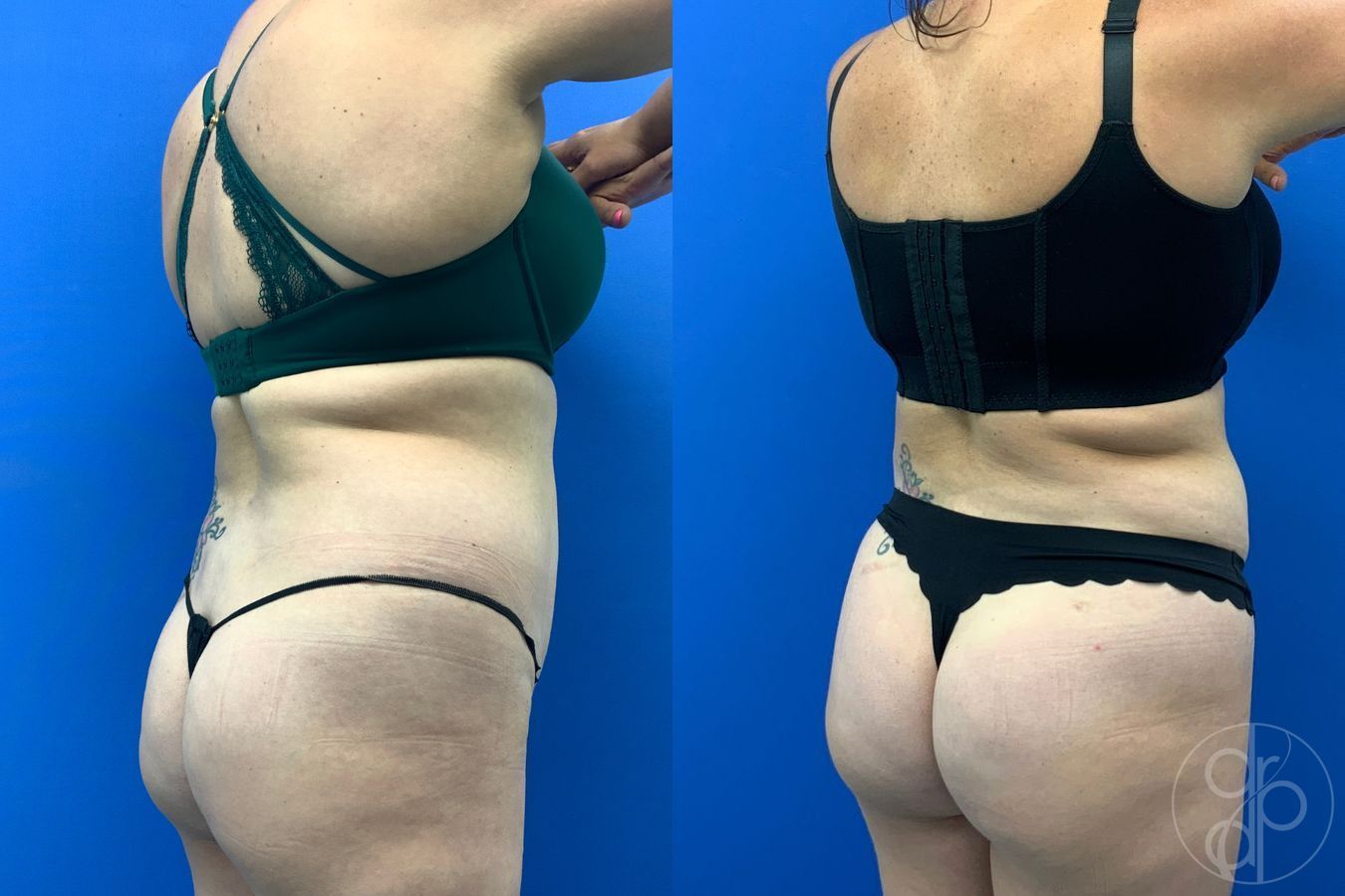 Before and after Liposuction case 43486 - Angle 4