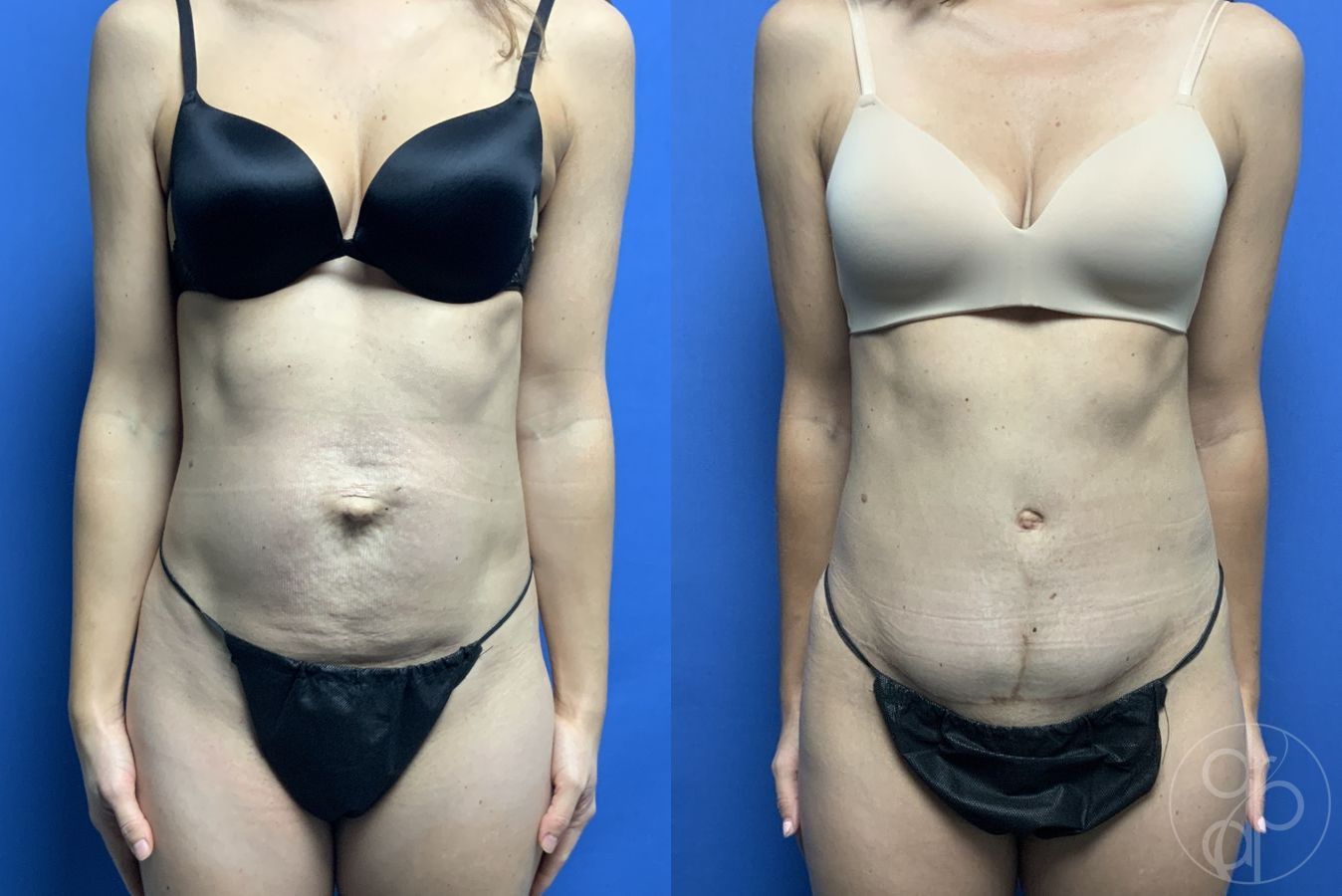 Before and after Abdominoplasty case 29567