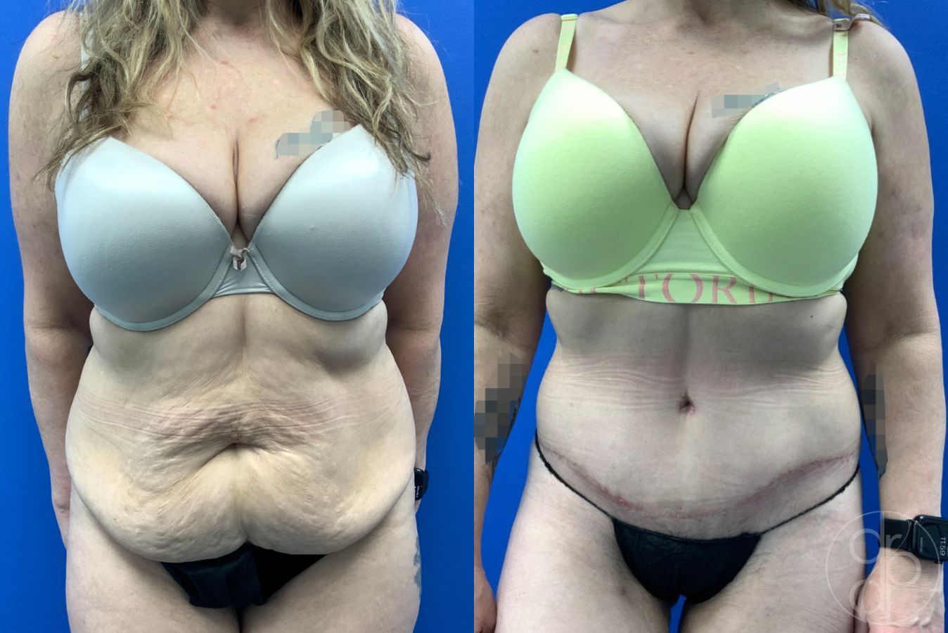 Before and after Abdominoplasty case 46426
