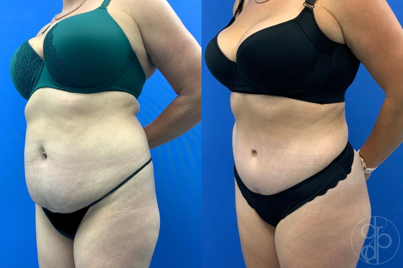 Before and after Liposuction case 43486 - Angle 8