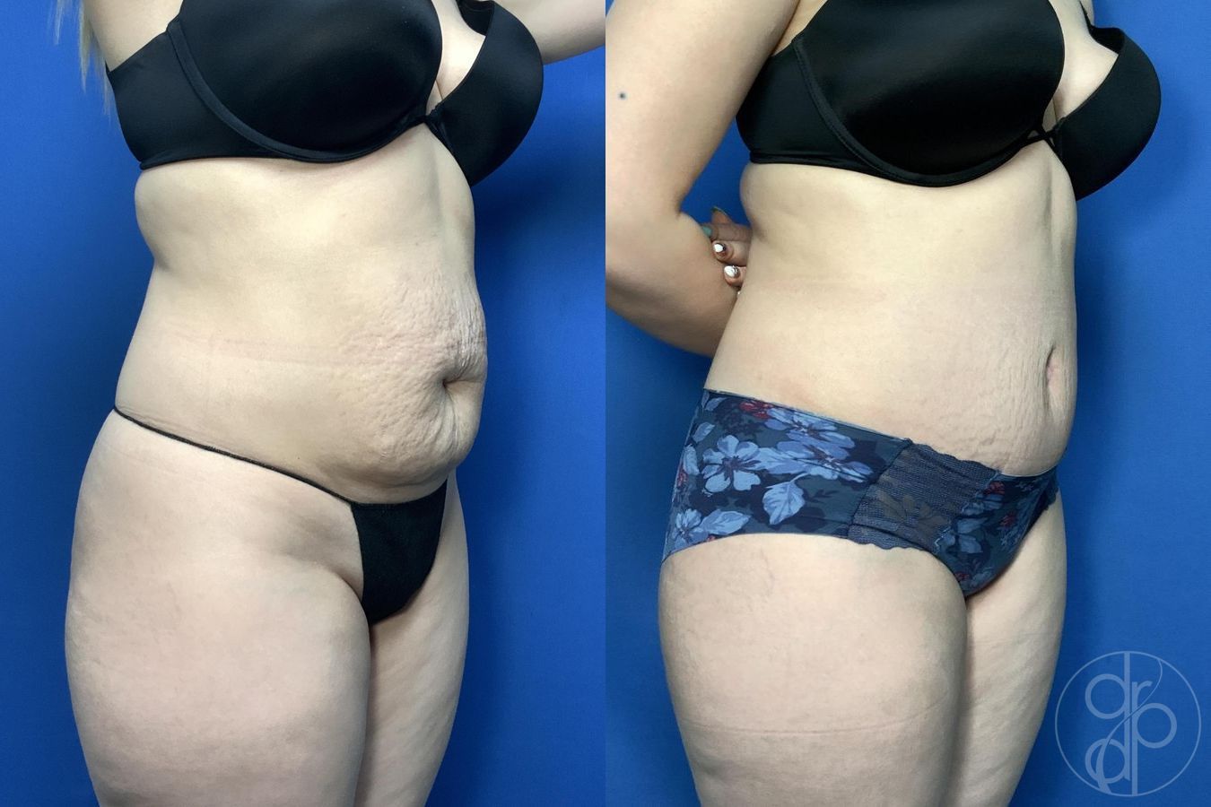 Before and after Abdominoplasty case 30006 - Angle 2
