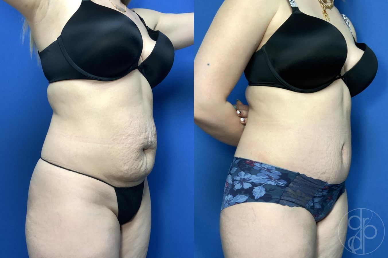 Before and after Abdominoplasty case 30006 - Angle 2