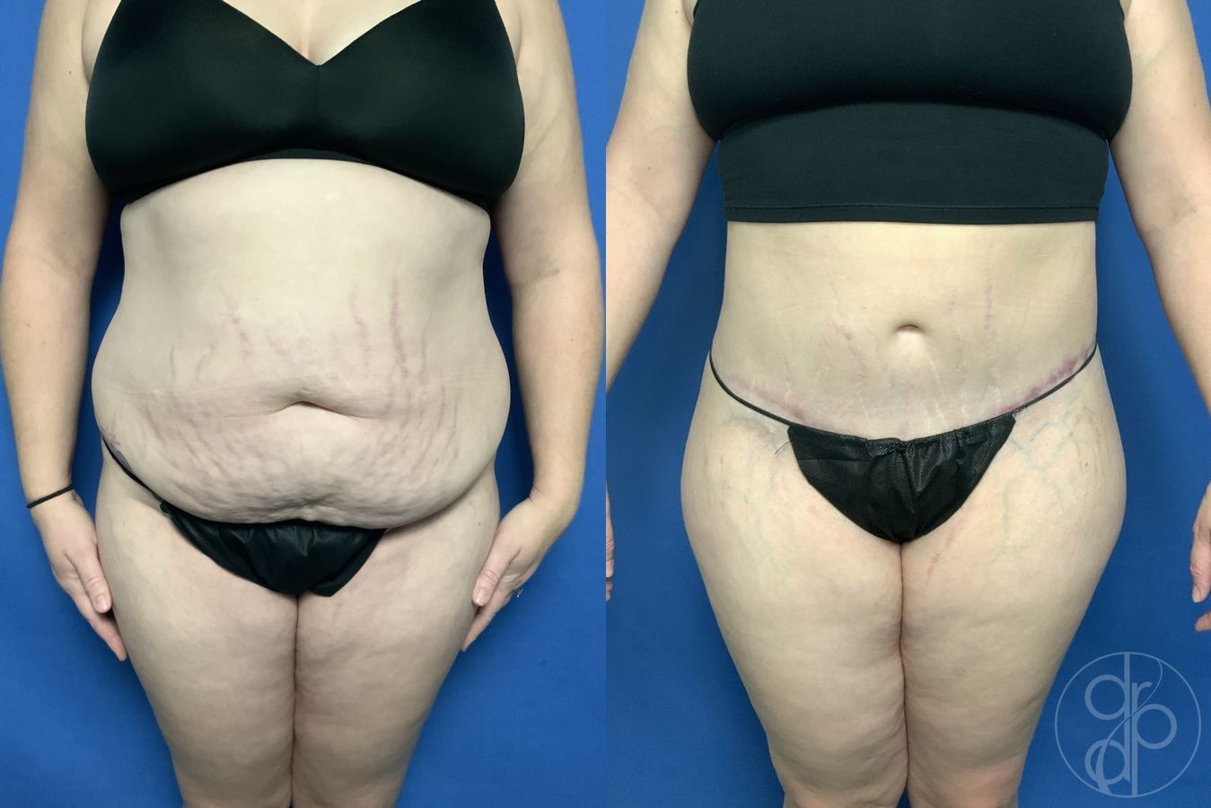 Before and after Abdominoplasty case 29576