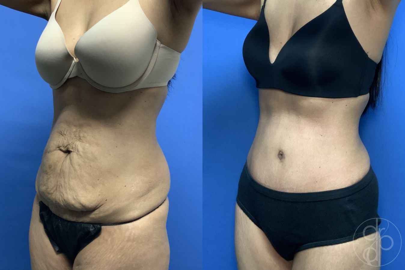 Before and after Abdominoplasty case 29540 - Angle 2