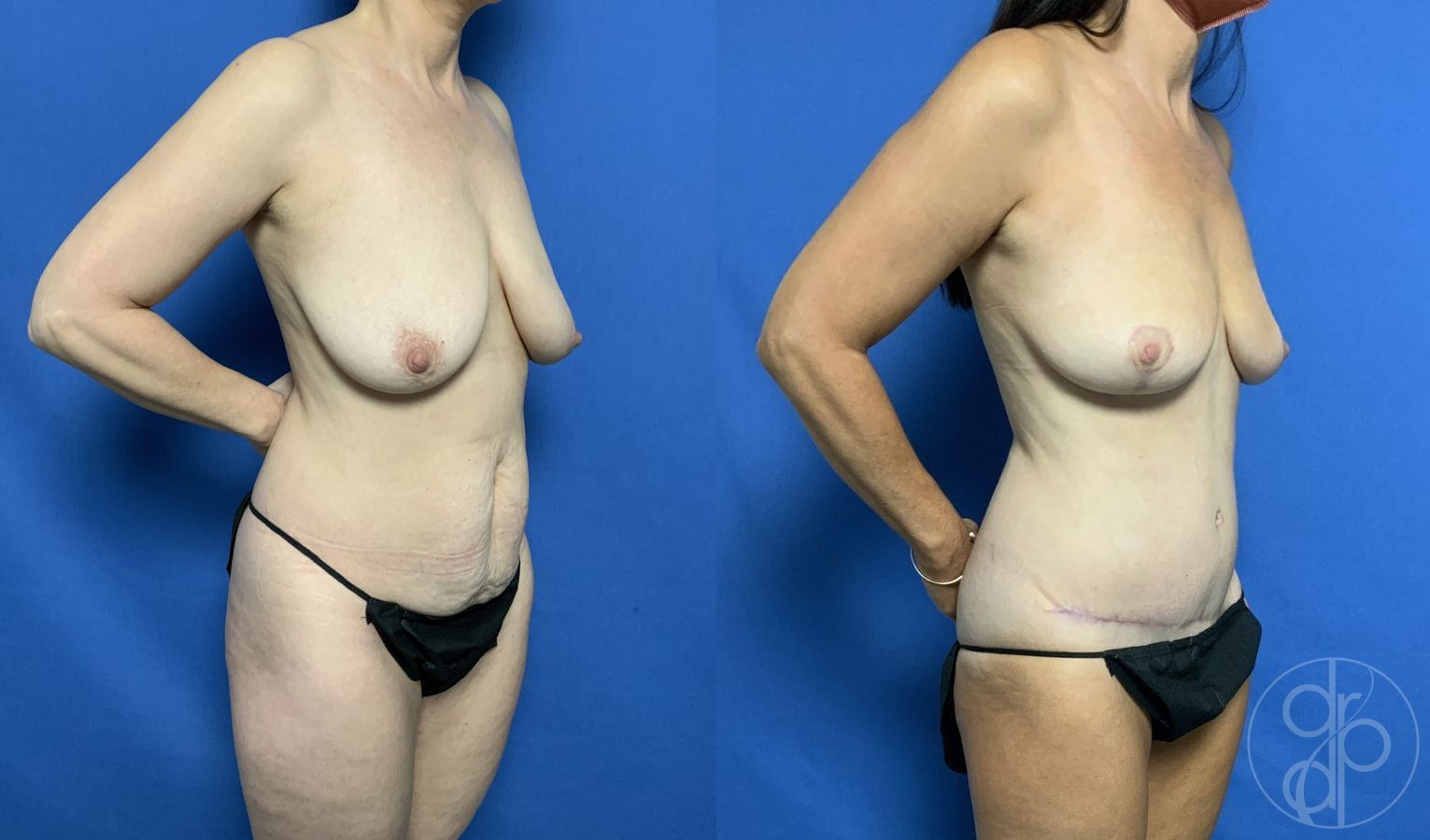 Before and after Abdominoplasty case 29693 - Angle 2