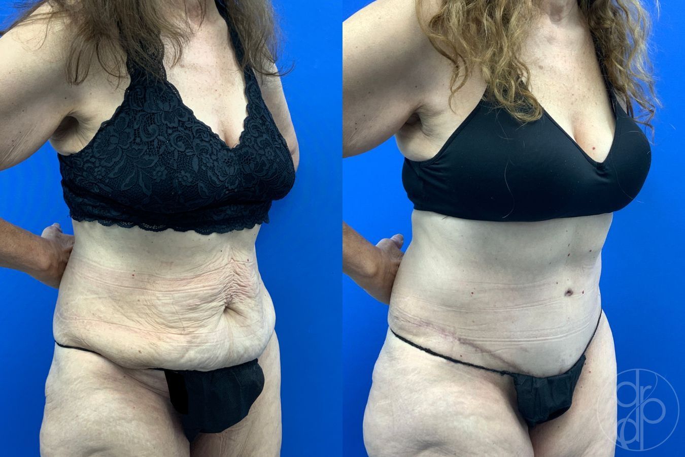 Before and after Abdominoplasty case 43198 - Angle 5