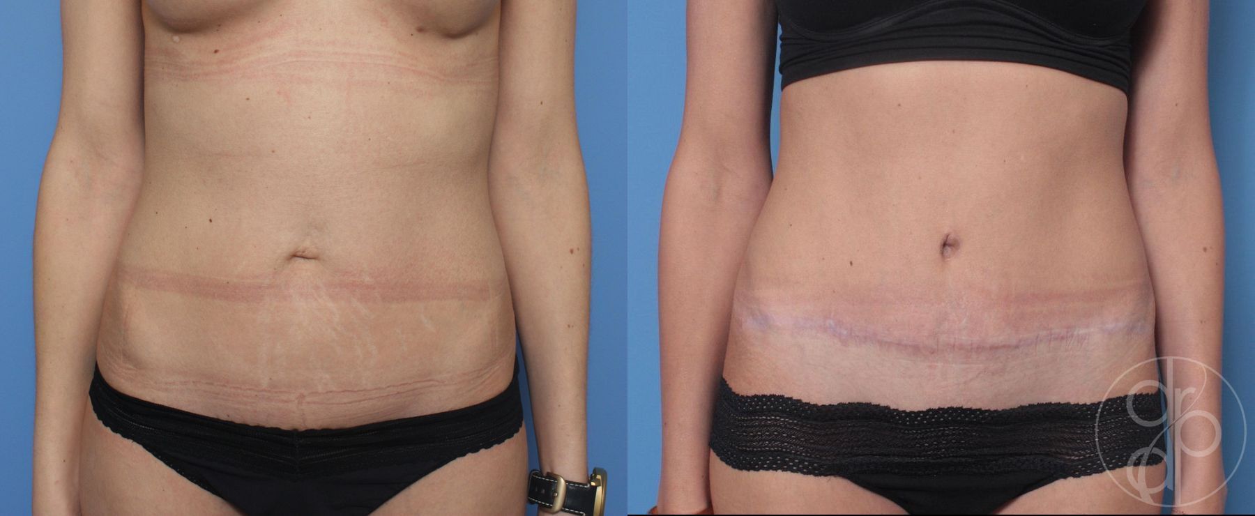 Before and after Abdominoplasty case 29522