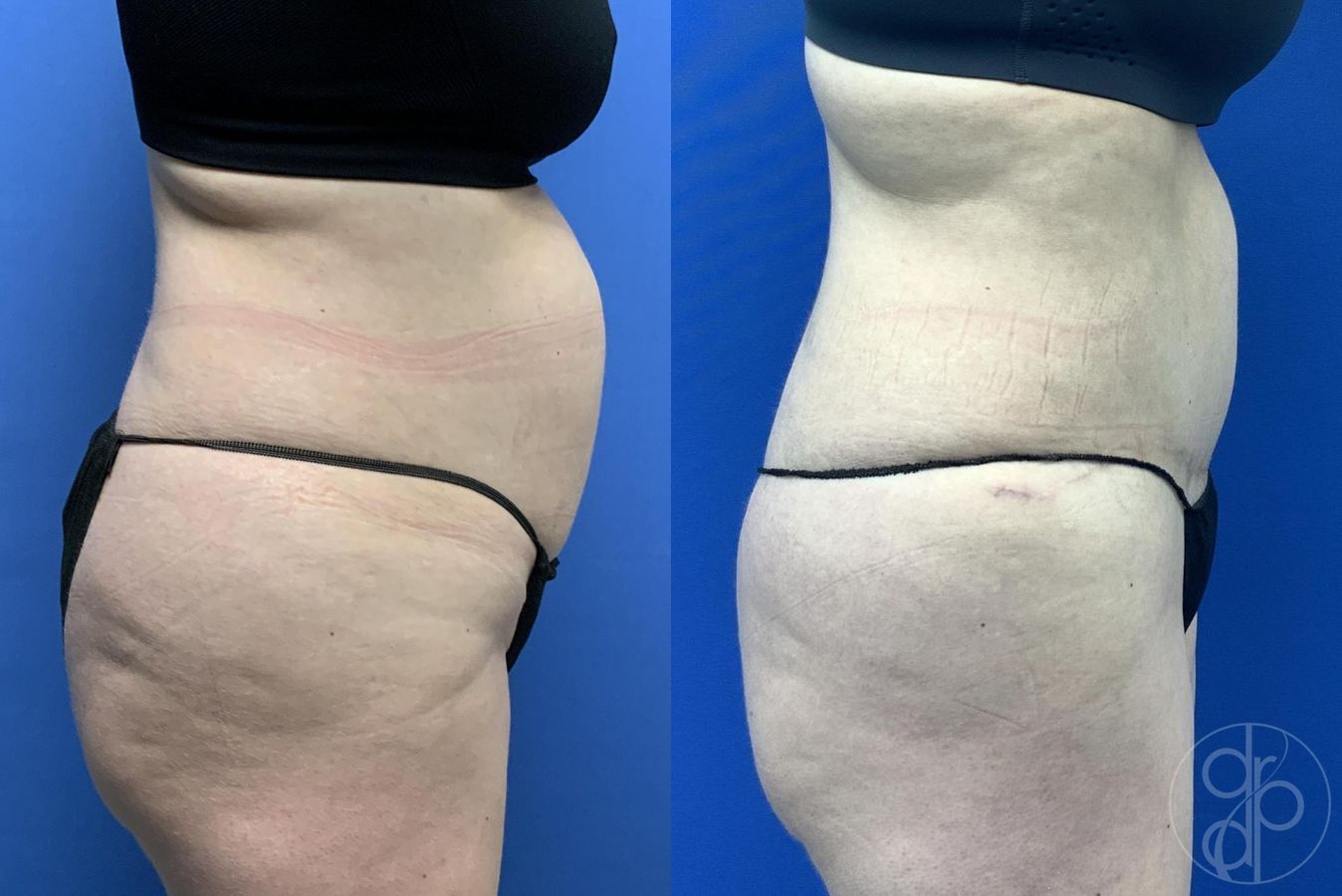 Before and after Abdominoplasty case 30018 - Angle 5