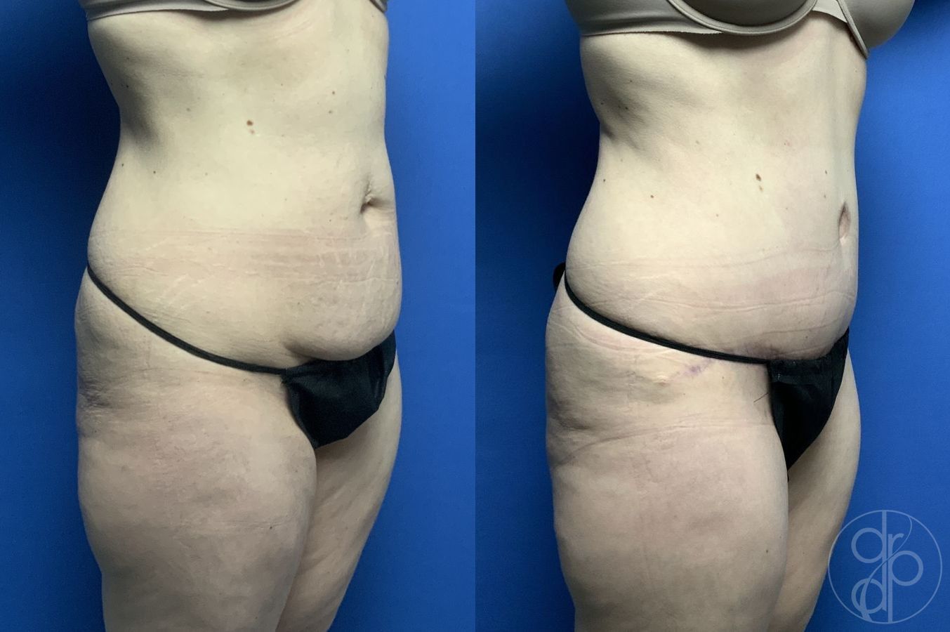Before and after Abdominoplasty case 29568 - Angle 2