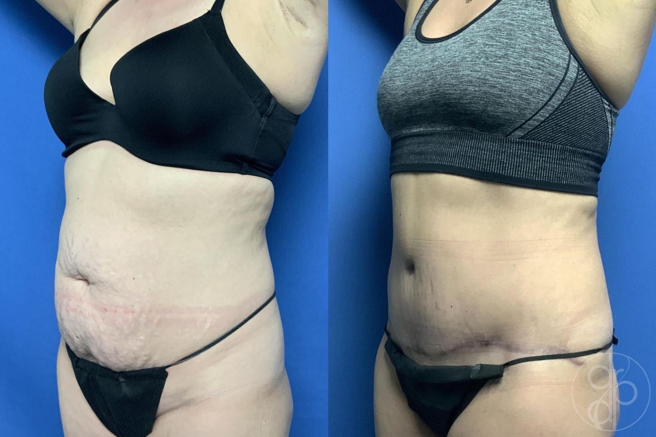 Before and after Abdominoplasty case 29563 - Angle 2