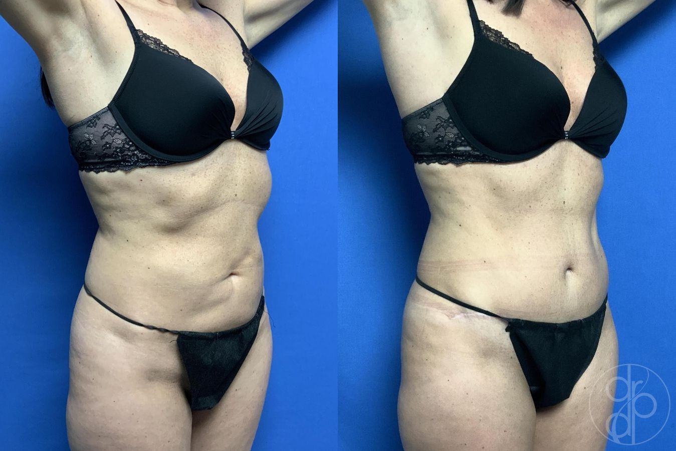 Before and after Abdominoplasty case 29613 - Angle 3