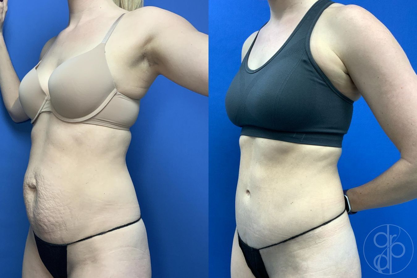 Before and after Abdominoplasty case 30012 - Angle 3