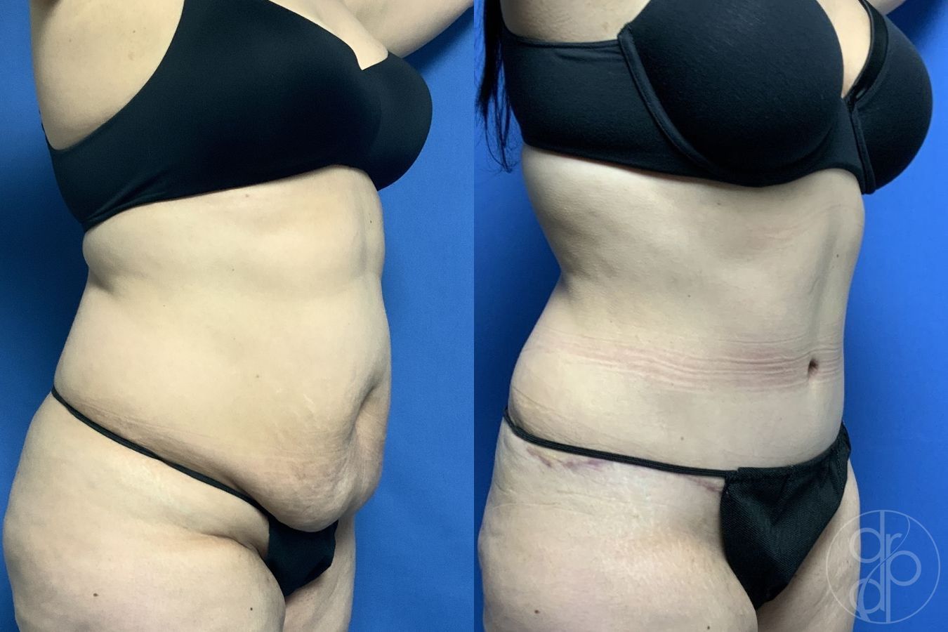 Before and after Abdominoplasty case 29575 - Angle 2