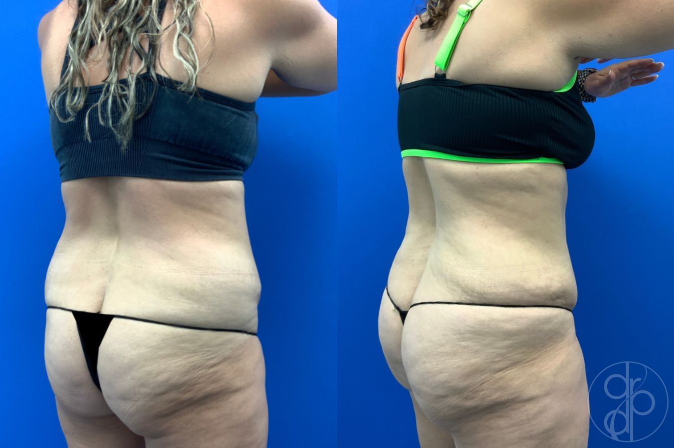 Before and after Liposuction case 43452 - Angle 5
