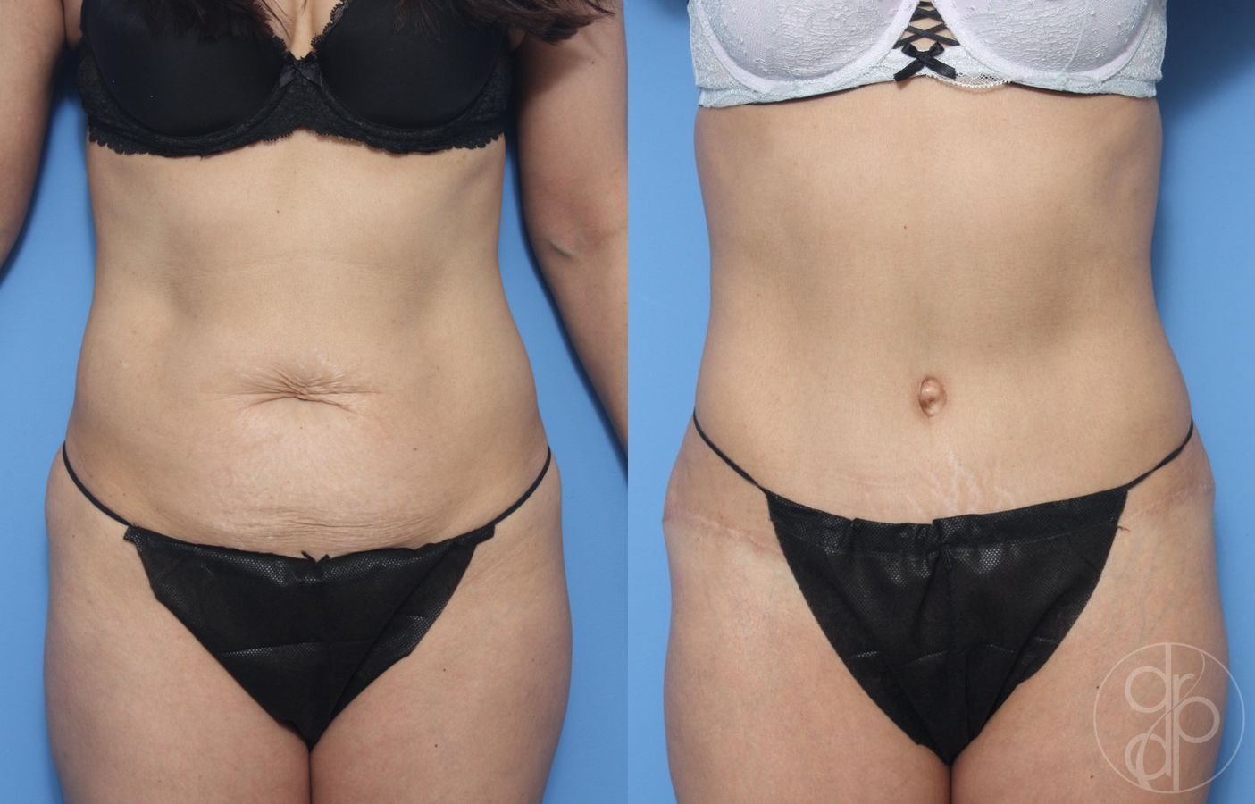 Before and after Abdominoplasty case 29524