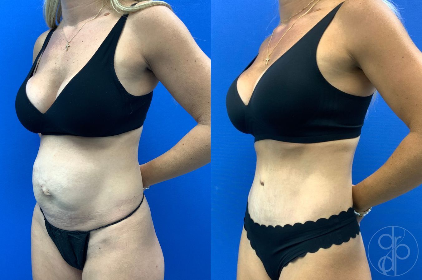 Before and after Abdominoplasty case 49485 - Angle 3