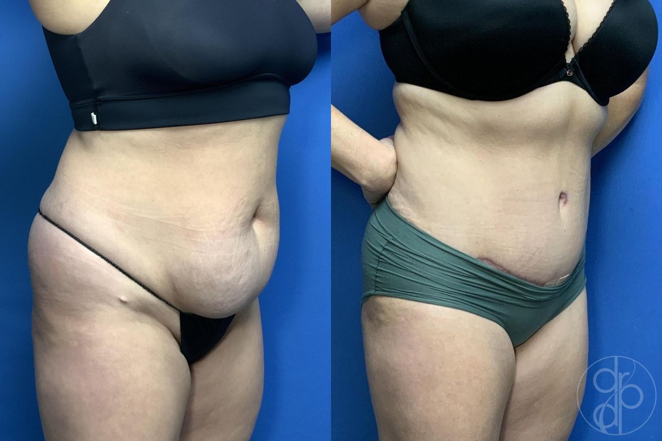 Before and after Abdominoplasty case 29993 - Angle 2