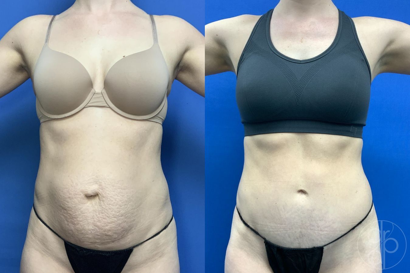 Before and after Abdominoplasty case 30012 - Angle 2