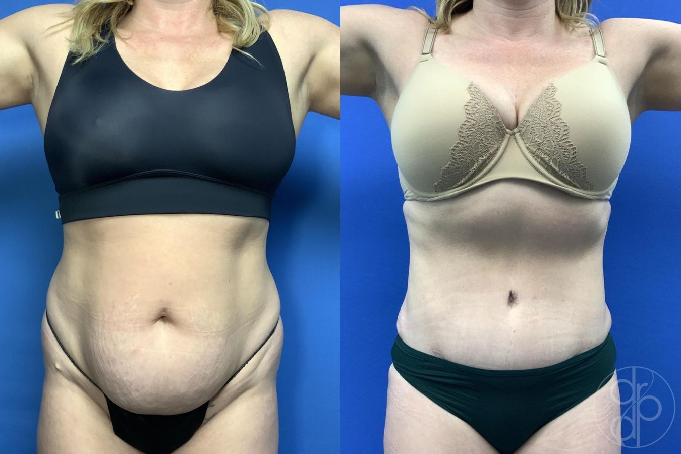Before and after Abdominoplasty case 29762 - Angle 2