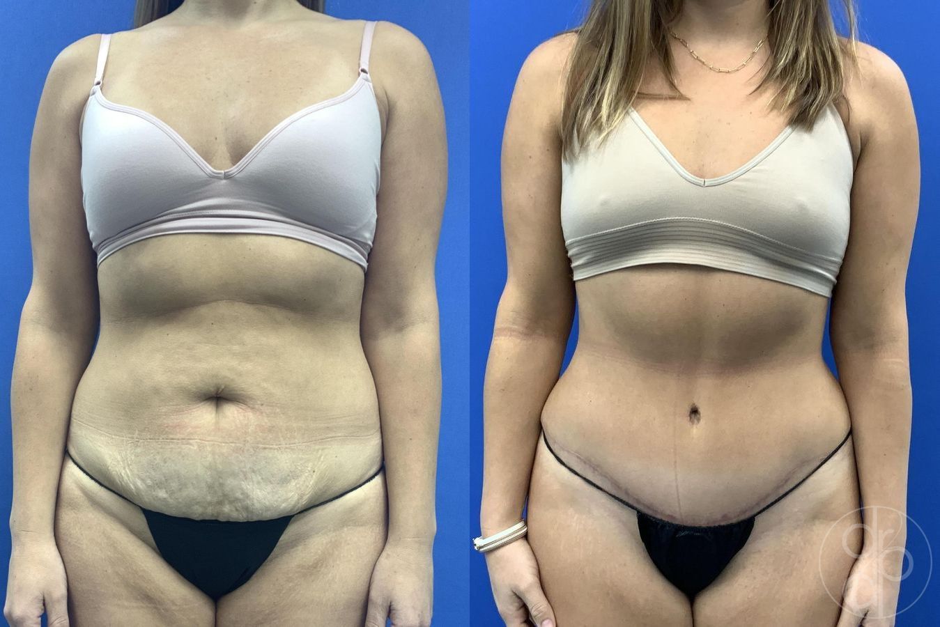 Before and after Liposuction case 30025
