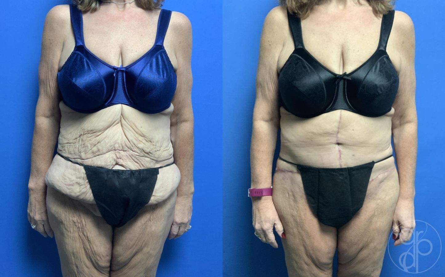 Before and after Abdominoplasty case 29528