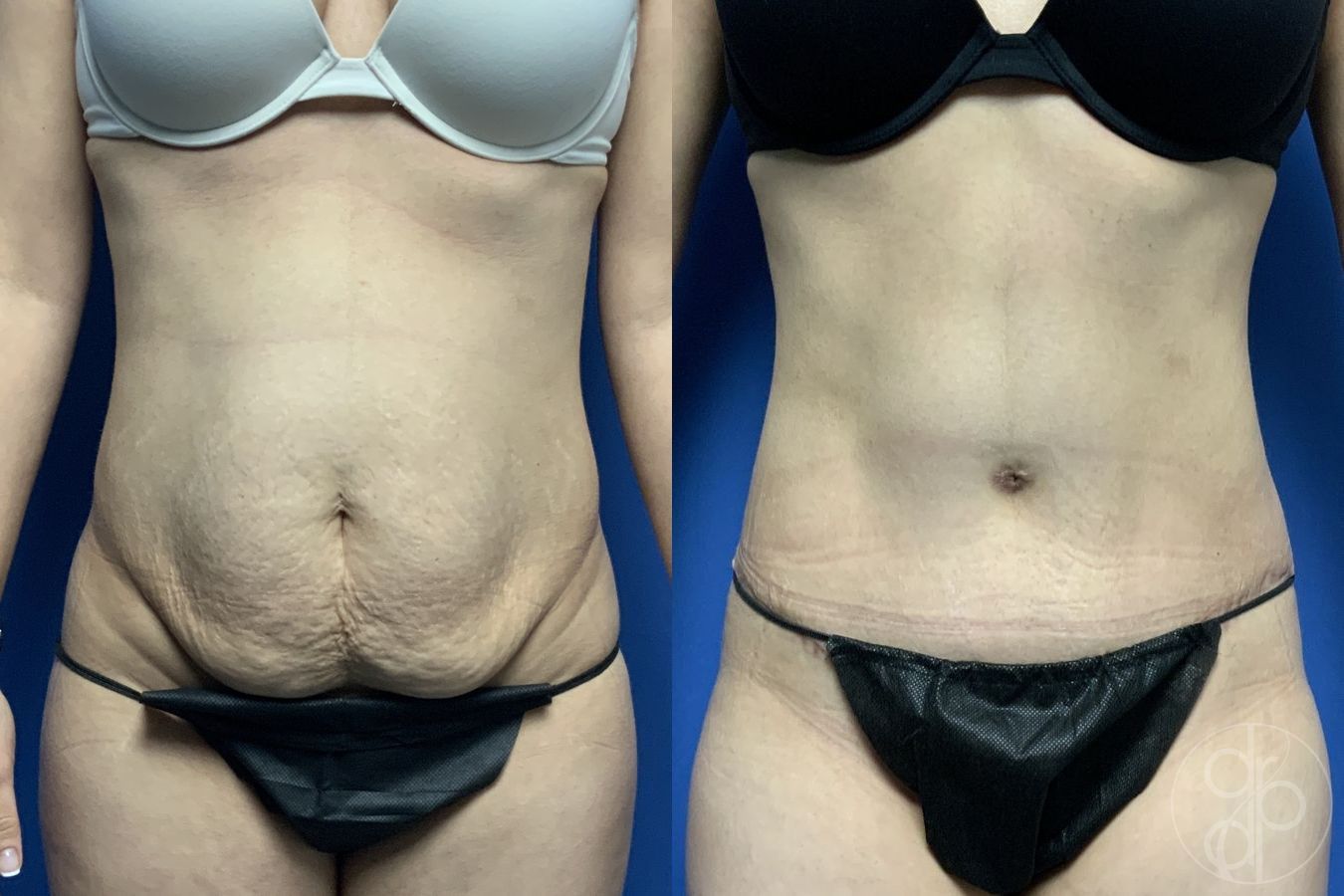 Before and after Abdominoplasty case 29565
