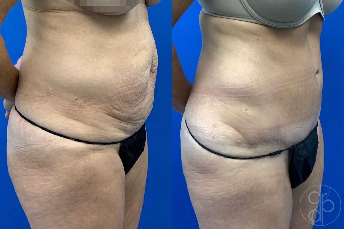 Before and after Abdominoplasty case 46417 - Angle 3