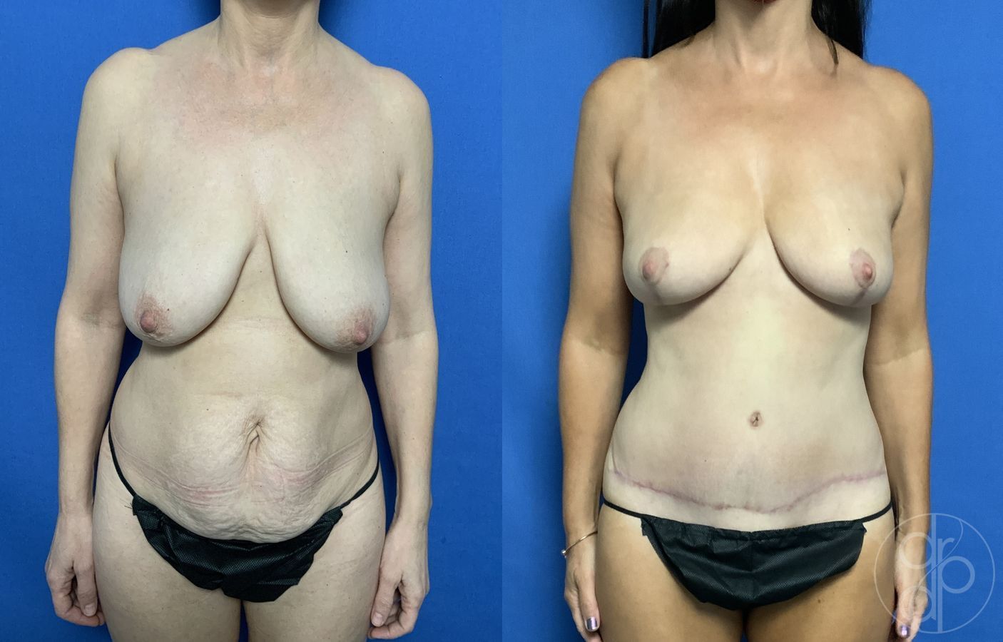 Before and after Abdominoplasty case 29693