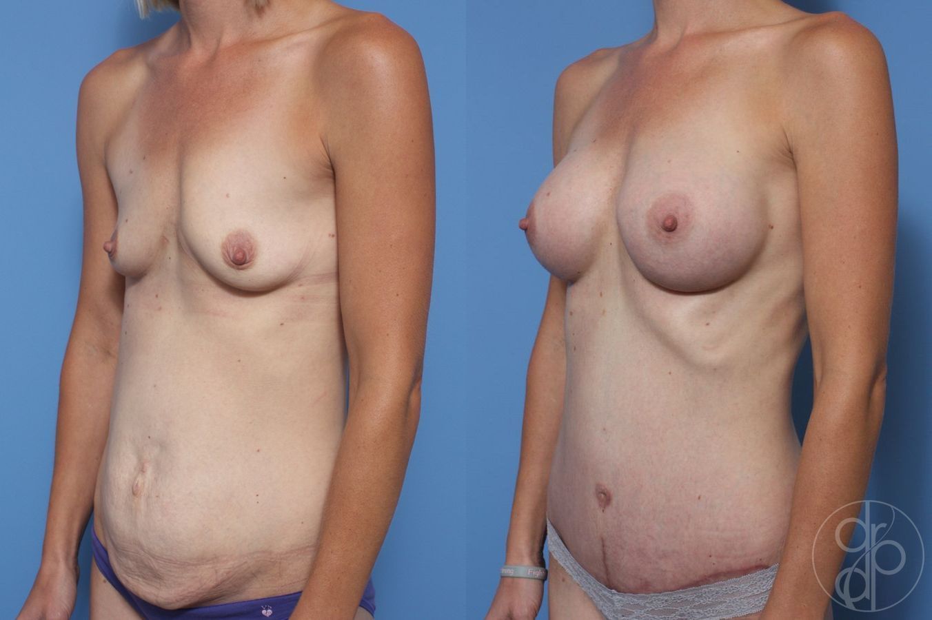 Before and after Abdominoplasty case 29692 - Angle 3