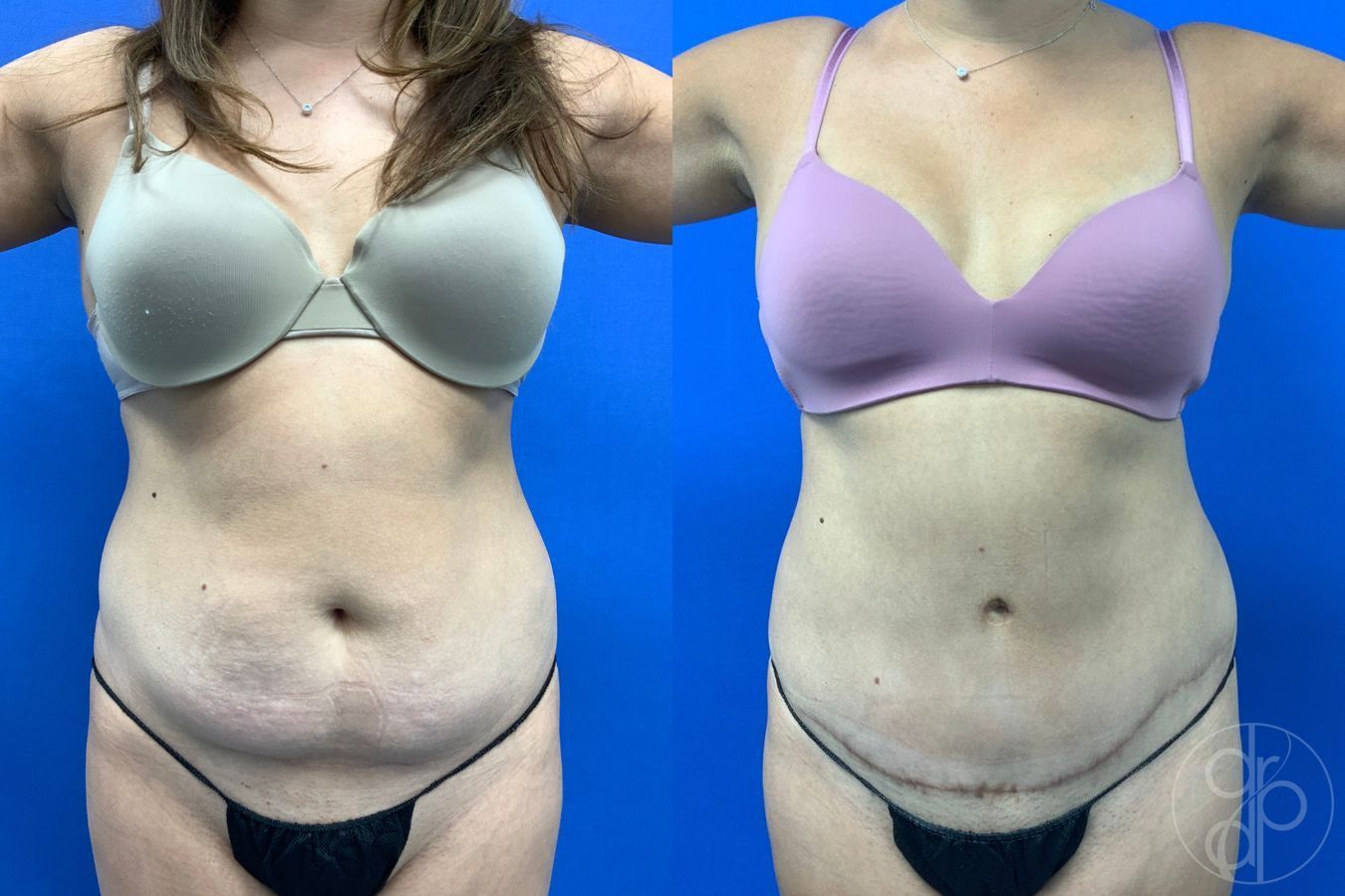 Before and after Abdominoplasty case 43451 - Angle 2