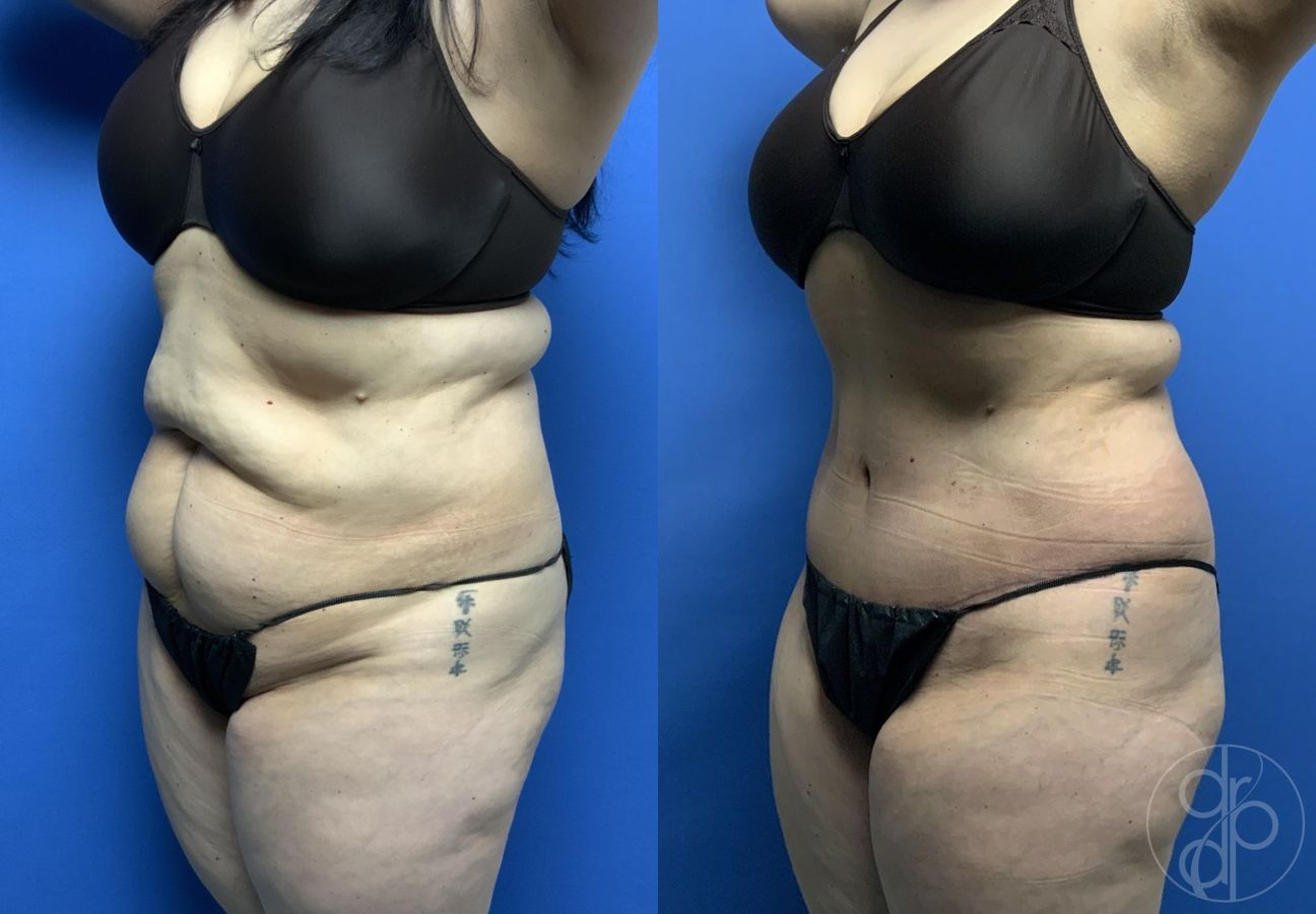 Before and after Abdominoplasty case 29569 - Angle 3