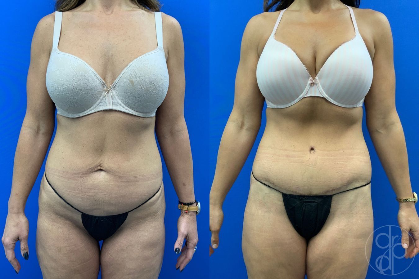 Before and after Abdominoplasty case 43480