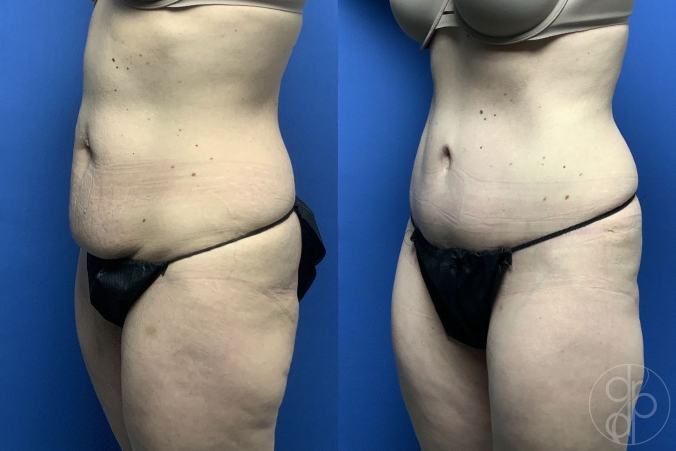 Before and after Abdominoplasty case 29568 - Angle 3